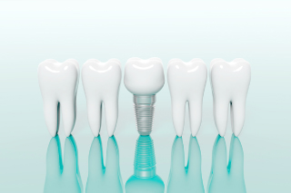 中央区篠原町・おおすぎファミリー歯科・インプラント